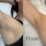 Hormonalne dlačice kod žena – zašto se pojavljuju i kako laserska epilacija pomaže
